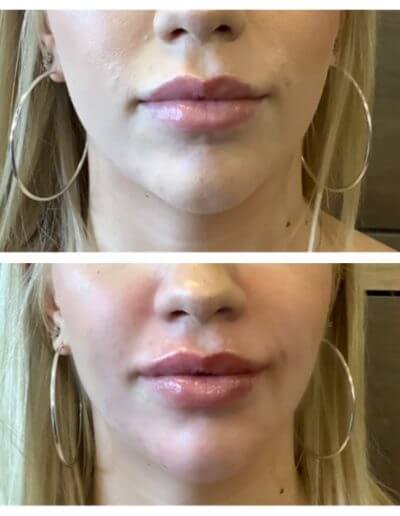 Lips and jaw line Before and After