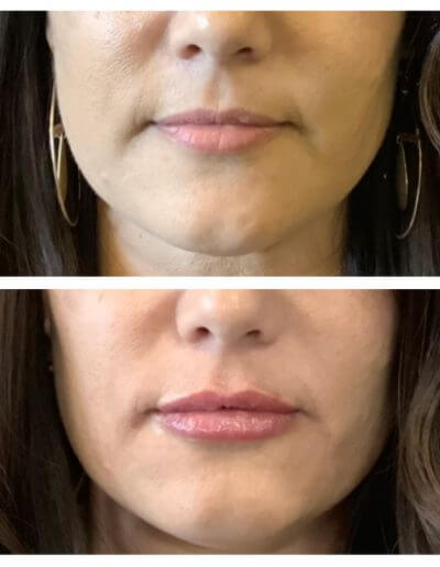 Lips Before and After
