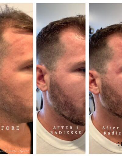 Radiesse Jawline before and after