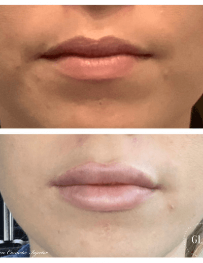 versa lips- before and after