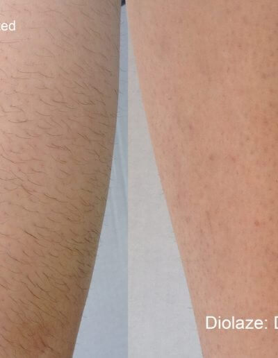 Laser Hair Removal Before and after