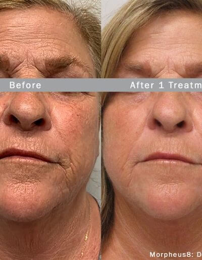 Morpheus8 before and after results