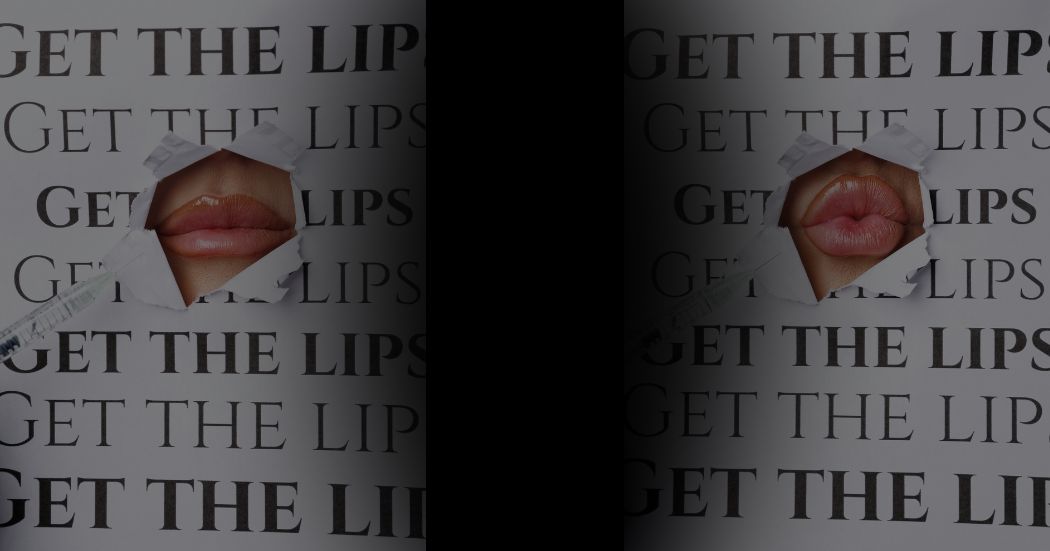 5 Reasons Your Lip Filler Migrated — and How to Actually Fix It