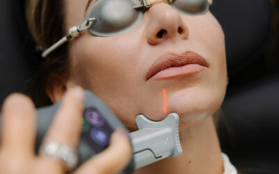 IPL Photofacial for Sun Damage: What to Expect Before, During & After